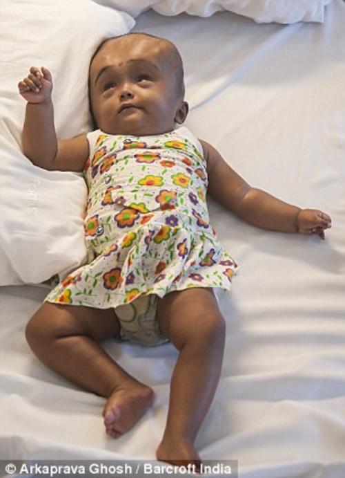 La peque&ntilde;a ya sonr&iacute;e con sus padres luego de varias cirug&iacute;as a las que fue sometida durante un a&ntilde;o en un hospital de Nueva Delhi.  (Foto: Daily Mail)