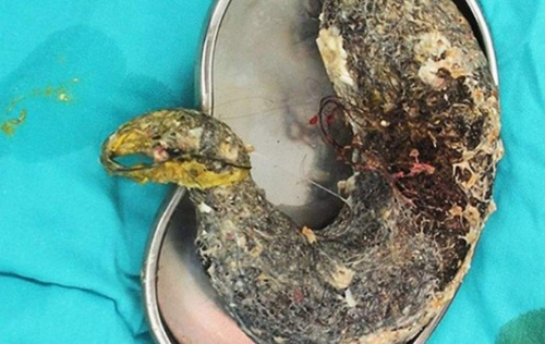 La bola de pelos formada en el est&oacute;mago de la ni&ntilde;a china