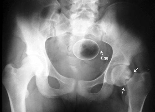 En algunas regiones de Iran se cree que introducir un huevo por el ano puede curar algunas enfermedades. (Foto: Radiopaedia)