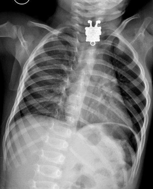 Jugar con piezas muy peque&ntilde;as hicieron que un ni&ntilde;o se tragara un mu&ntilde;eco de Bob Esponja. (Foto: Radiopaedia)