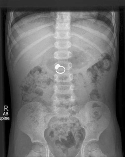 Un ni&ntilde;o se trag&oacute; un anillo y su travesura qued&oacute; registrada en esta radiograf&iacute;a. (Foto: Radiopaedia)