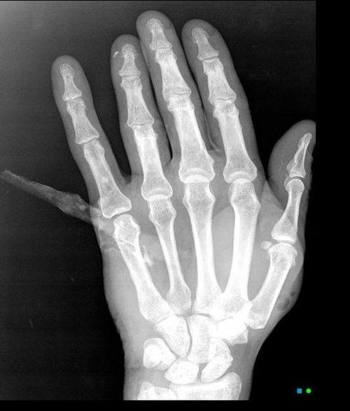 Una astilla grande se clav&oacute; en la mano de una paciente. (Foto: Radiopaedia)