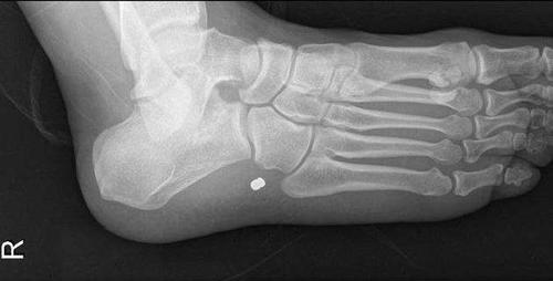 Un hombre que hab&iacute;a estado en un tiroteo tuvo que ser llevado al hospital donde descubrieron que una bala se hab&iacute;a alojado en su pie. (Foto: Radiopaedia)