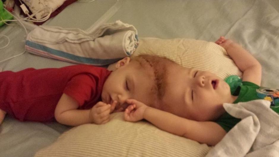 Los hermanitos fueron sometidos a la cirug&iacute;a para mejorar su calidad de vida (Foto: Infobae)