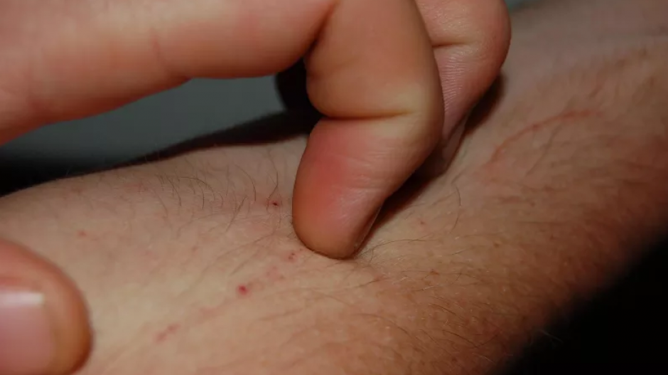 Esa molesta sensaci&oacute;n empeora rasc&aacute;ndote. (Foto: Gizmodo)