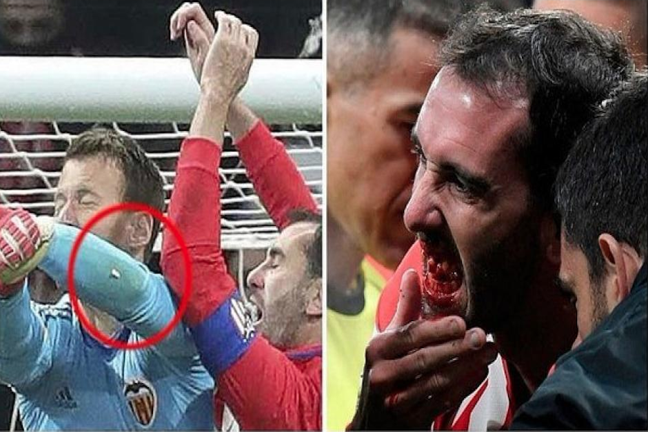 El uruguayo perdi&oacute; tres dientes tras impactar contra el guardameta del Valencia FC. (Imagen: Marca)