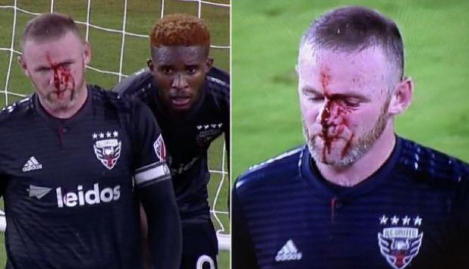 Rooney tuvo que abandonar el partido con la nariz rota. (Foto: Depor)