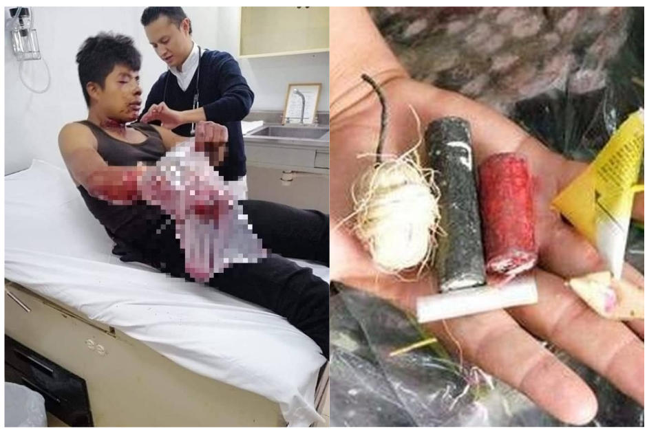 El hombre podr&iacute;a perder toda la mano derecha. (Fotos Facebook)