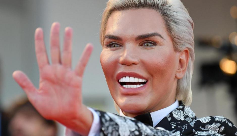 Rodrigo Alves no quiere perder su juventud y por eso se ha sometido a la operaci&oacute;n para recuperar cabello en zonas calvas. (Foto: El Comercio)