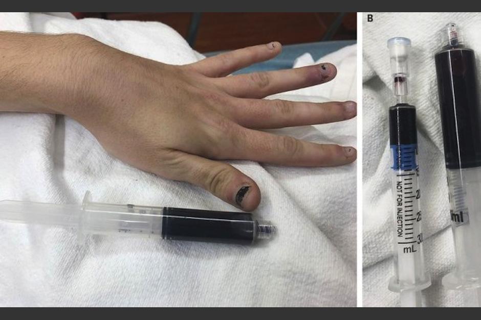 Una mujer que llegó al hospital con cansancio y difucultades respiratorias tenía la sangre de color azul. (Foto: The new England Journal of Medicine)&nbsp;