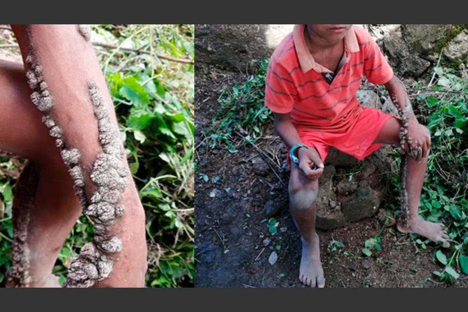 La condici&oacute;n de Antony se ha visto con anterioridad en La India. (Foto Tiempo Honduras)