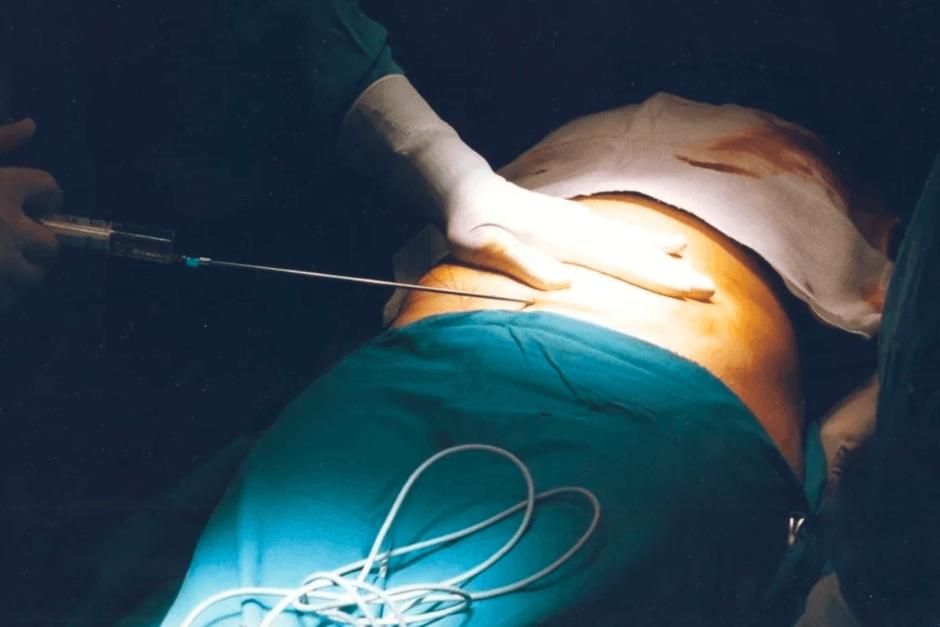 El médico practicó una liposucción y dejó con una hemorragia a la joven, lo que le costó la vida. (Foto con fines ilustrativos / Laverdadnoticias )&nbsp;