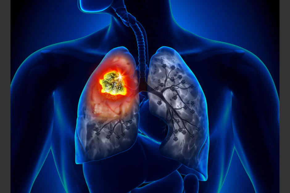 Especialistas investigan el c&aacute;ncer de pulm&oacute;n como posible secuela del Covid-19. (Foto: Pixabay)