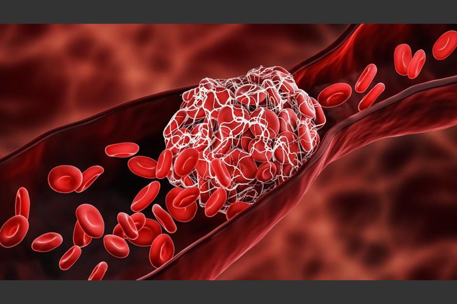 La investigación resalta que el riesgo de padecer coágulos sanguíneos es más alto sin tener la vacuna contra el Covid-19. (Foto: Istock)