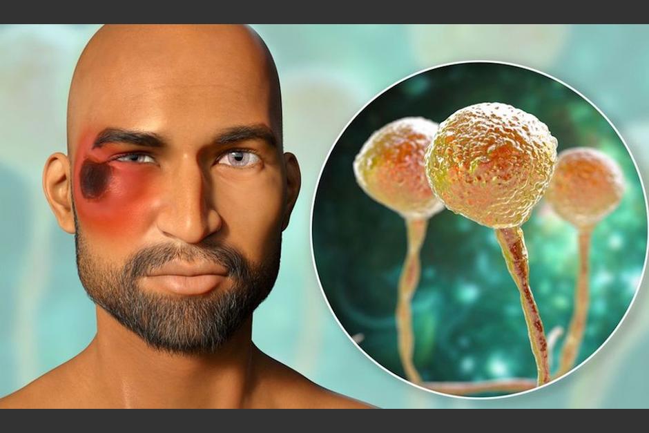 El hongo negro es una infección no contagiosa entre humanos y animales. (Foto: UNAM, México)