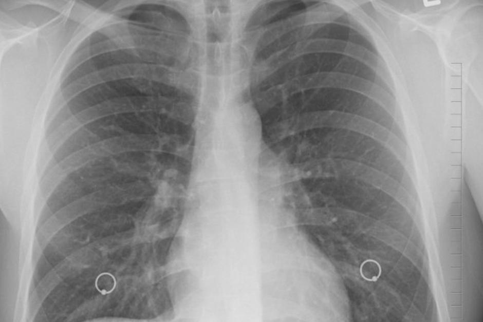 Los pulmones quedan más dañados luego de padecer coronavirus que los de un fumador. (Foto: Pixabay)