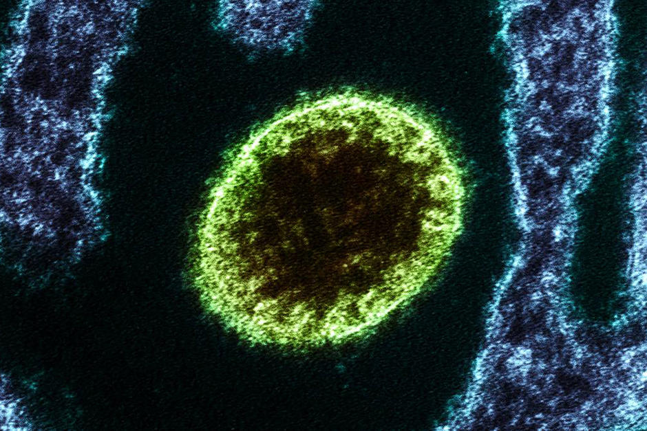 El virus Nipah es tendencia en redes sociales y pese a que sí existe y es mortal, la OMS no ha emitido ninguna alerta por brote. (Foto: www.sciencephoto.com)
