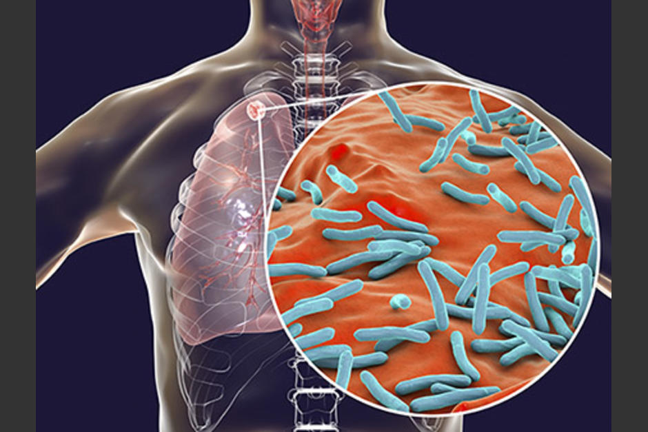 Por primera vez en m&aacute;s de diez a&ntilde;os, aumentan los muertos por esta enfermedad, debido a los efectos de la pandemia. (Foto:&nbsp;www.uab.edu)