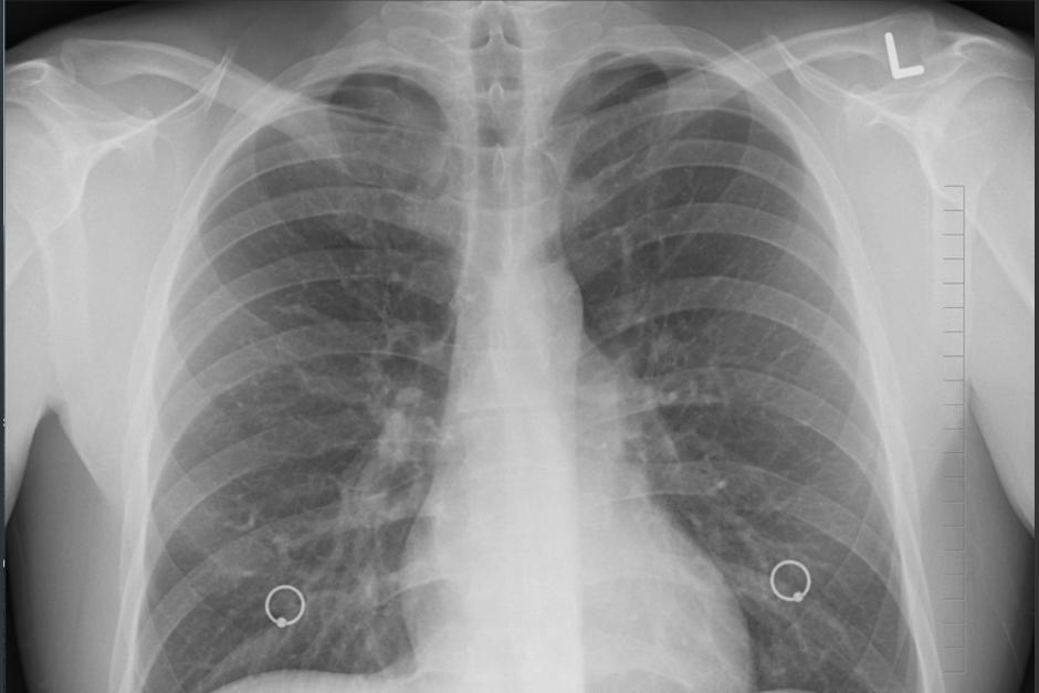 El c&aacute;ncer de pulm&oacute;n es el m&aacute;s mort&iacute;feros de todos los c&aacute;ncer. (Foto: Pixabay)