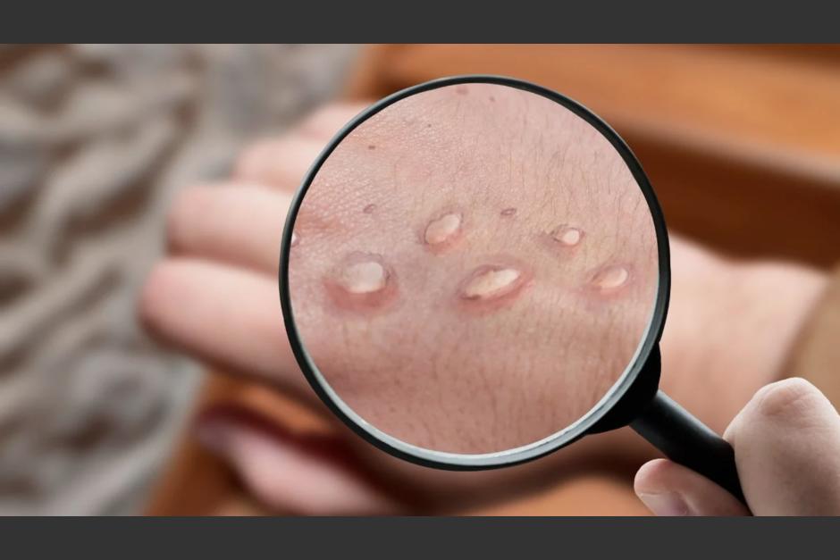 Hay un grupo de la poblaci&oacute;n que podr&iacute;a tener inmunidad contra la viruela del mono. (Foto: Redes Sociales)