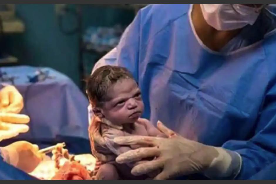 La foto de la beb&eacute; Isabel Pereira de Jes&uacute;s se hizo viral por su "ce&ntilde;o fruncido" al nacer. (Foto:&nbsp;Instagram @rodrigokunstmann)