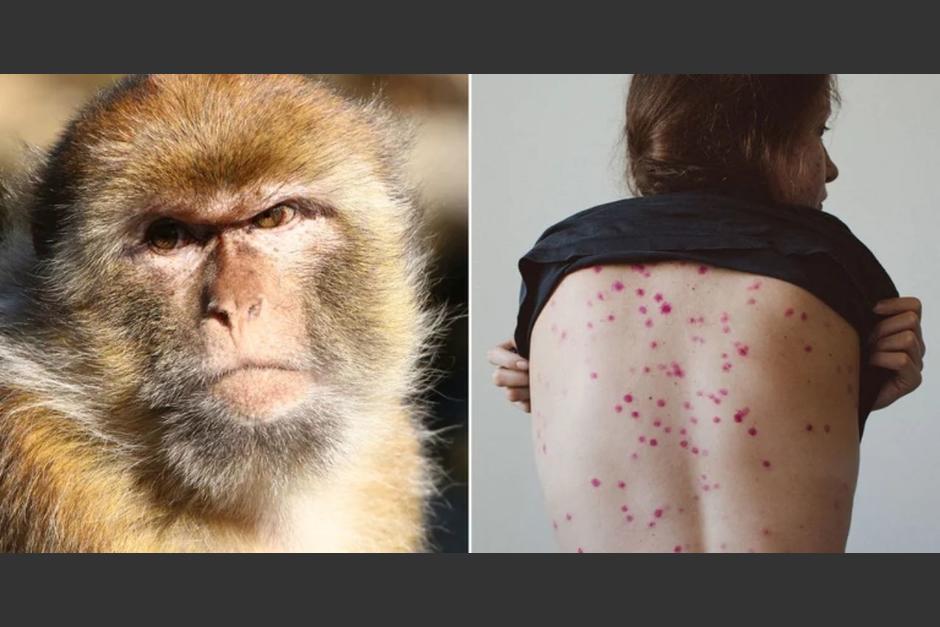 Las recientes detecciones de casos de viruela del mono se han efectuado en hombres jóvenes, confirman los expertos. (Foto ilustrativa: notife.com)