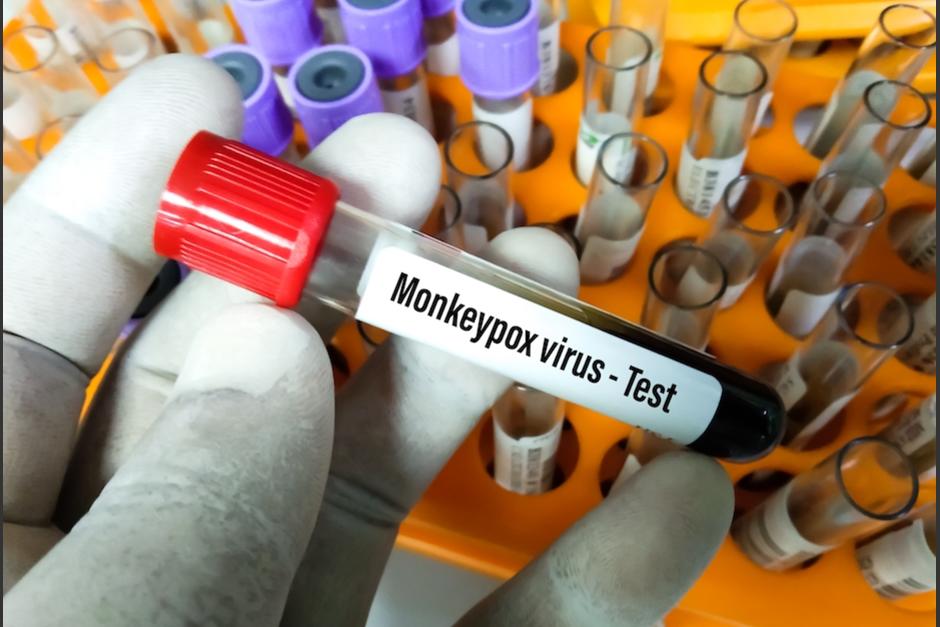 Estados Unidos planea distribuir vacunas de la viruela del mono y tratamientos médicos a los contactos cercanos de personas infectadas, cuando ya hay cinco casos confirmados o probables en ese país. (Foto: Shutterstock)