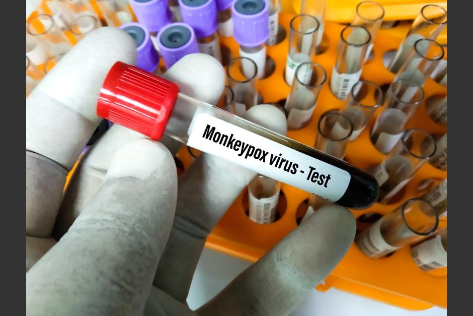 La viruela del mono ha causado alerta, tras detección de casos en varios países. (Foto: Shutterstock)