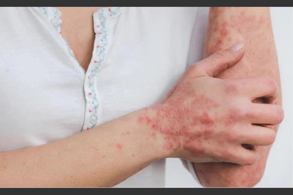 La Organizaci&oacute;n Mundial de la Salud (OMS) asegur&oacute; que actualmente no hay tema que la propagaci&oacute;n del virus de la viruela del mono m&aacute;s all&aacute; de los pa&iacute;ses africanos pueda provocar una pandemia mundial. (Foto ilustrativa: www.viveusa.mx)&nbsp;