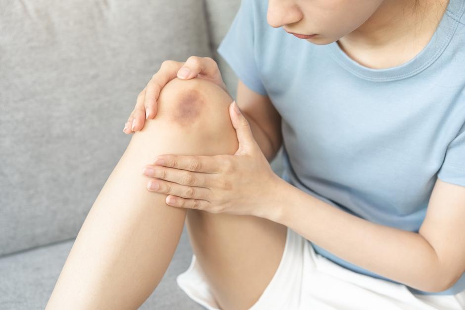 Los moretones "inexplicables" podrían tener su razón de ser. (Foto: Shutterstock)