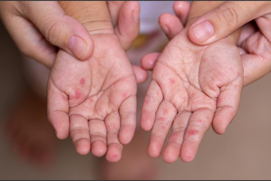 Autoridades advierten que tras la Semana Santa podr&iacute;a registrarse un repunte (Foto: Shutterstock)