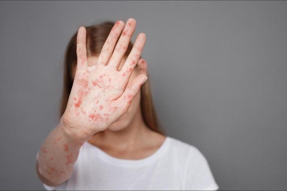 La vacunaci&oacute;n es vital para prevenir la enfermedad (Foto: Shutterstock)