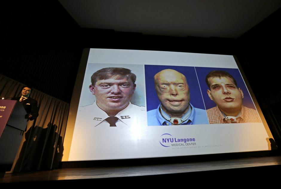 El doctor Eduardo Rodríguez (i), quien realizó el trasplante facial del exbombero Patrick Hardison, presenta las fotografías del rostro de su paciente antes y después de la operación. (Foto: EFE/Peter Foley)