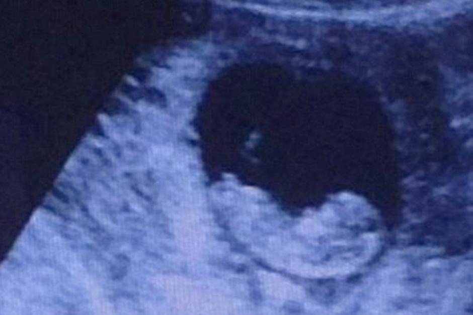 EL ultrasonido de un beb&eacute; causa revuelo en redes sociales. (Foto: Imgur)