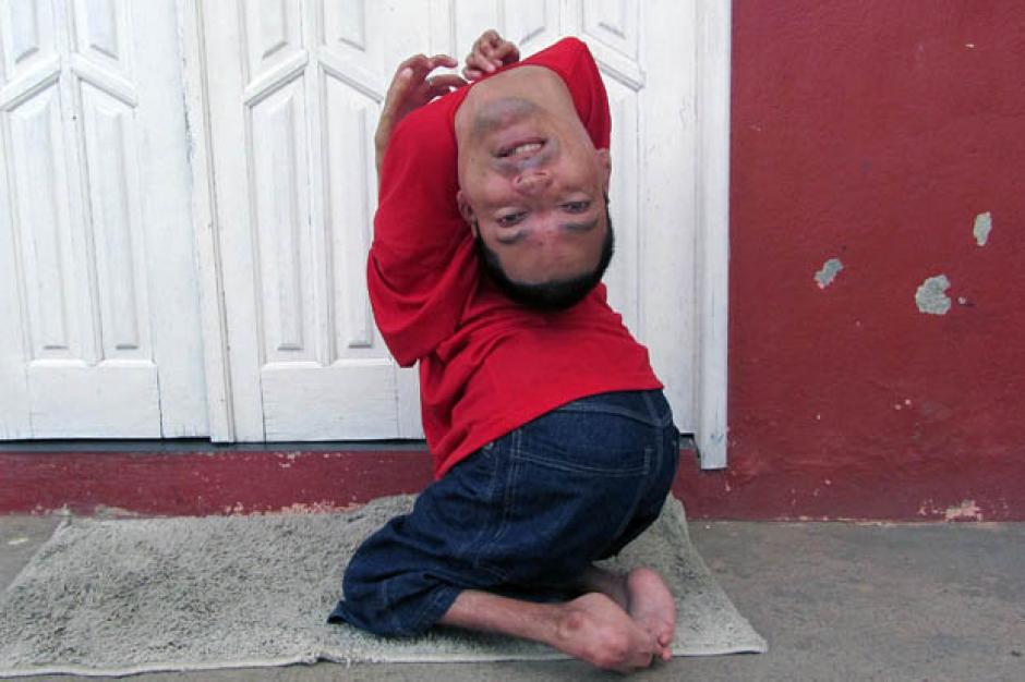 Claudio Vieira de Oliveria naci&oacute; en Brasil con una extra&ntilde;a enfermedad que hace pensar que su cabeza est&aacute; al rev&eacute;s. (Foto: Facebook)&nbsp;