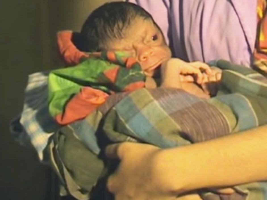 La condici&oacute;n de este beb&eacute; afecta al organismo y hace que envejezca ocho veces m&aacute;s r&aacute;pido. (Foto: Captura de video)