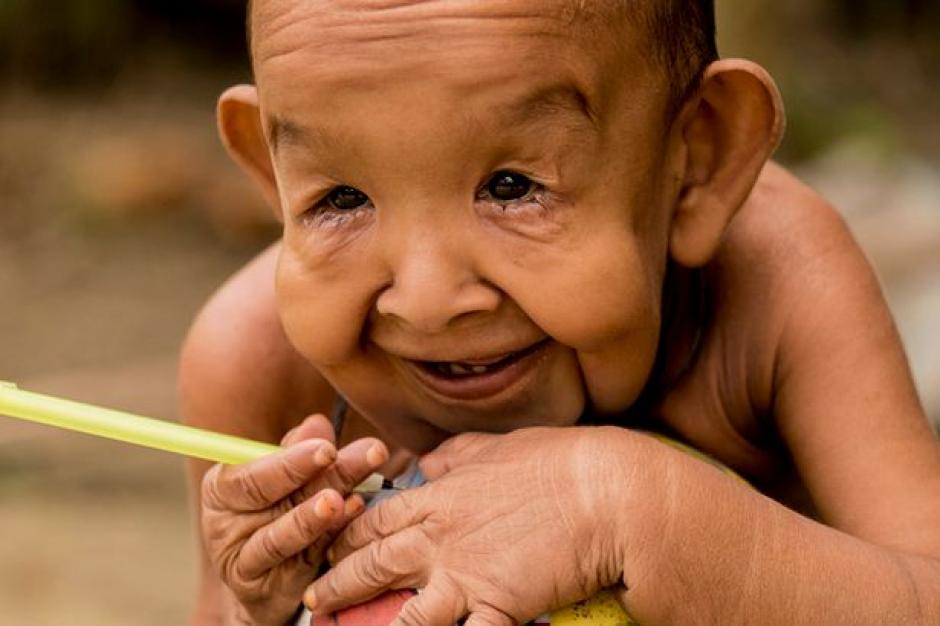 El peque&ntilde;o Bayezid Hossain padece de Progeria y Cutis Laxa. (Foto: elciudadano)