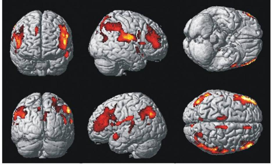&nbsp;Resonancia magn&eacute;tica volum&eacute;trica de la esquizofrenia. Foto por CIHR_IRSC en Flickr.