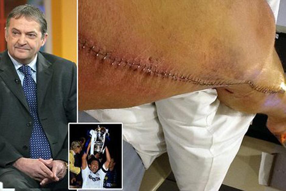 Gary Mabbutt necesit&oacute; de un corte de 30 pulgadas en su pierna y una sutura de 112 grapas para no perder su extremidad. (Foto: dailymail.co.uk)