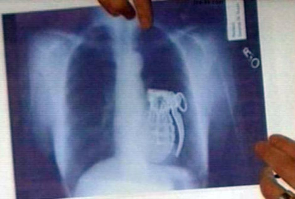 Una granada fue encontrada en el cuerpo de esta persona. (Foto: Taringa)