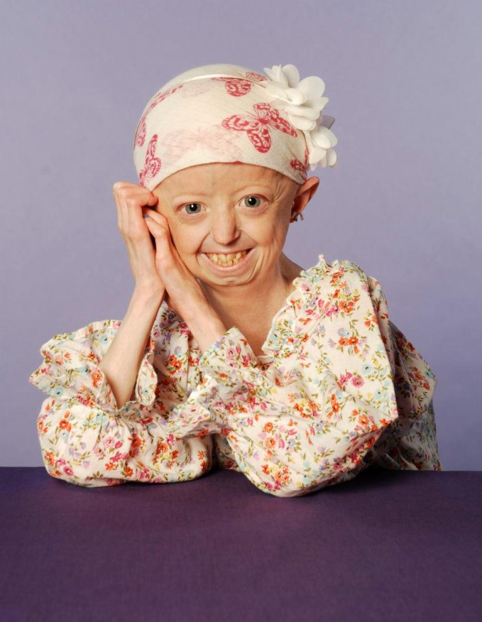 Hayley Okines murió a los 17 años por progeria. (Foto:Facebook)