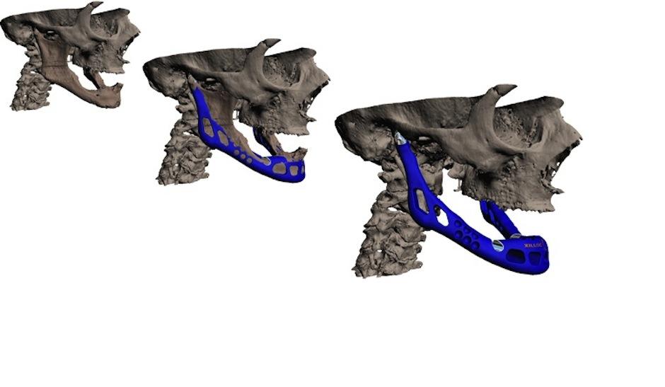 Existen impresoras en 3D que ya son capaces de imprimir huesos en 3D. (Foto: impresoras3d.com.uy)