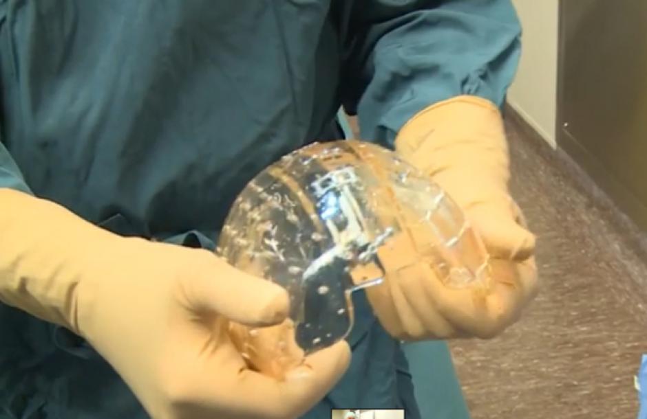 La paciente, cuya identidad no se ha revelado por cuestiones de privacidad, puede hacer ahora una vida normal sin controles exhaustivos, entre otras cosas porque el implante craneal tiene un car&aacute;cter permanente. (Foto: UMC Utretch)