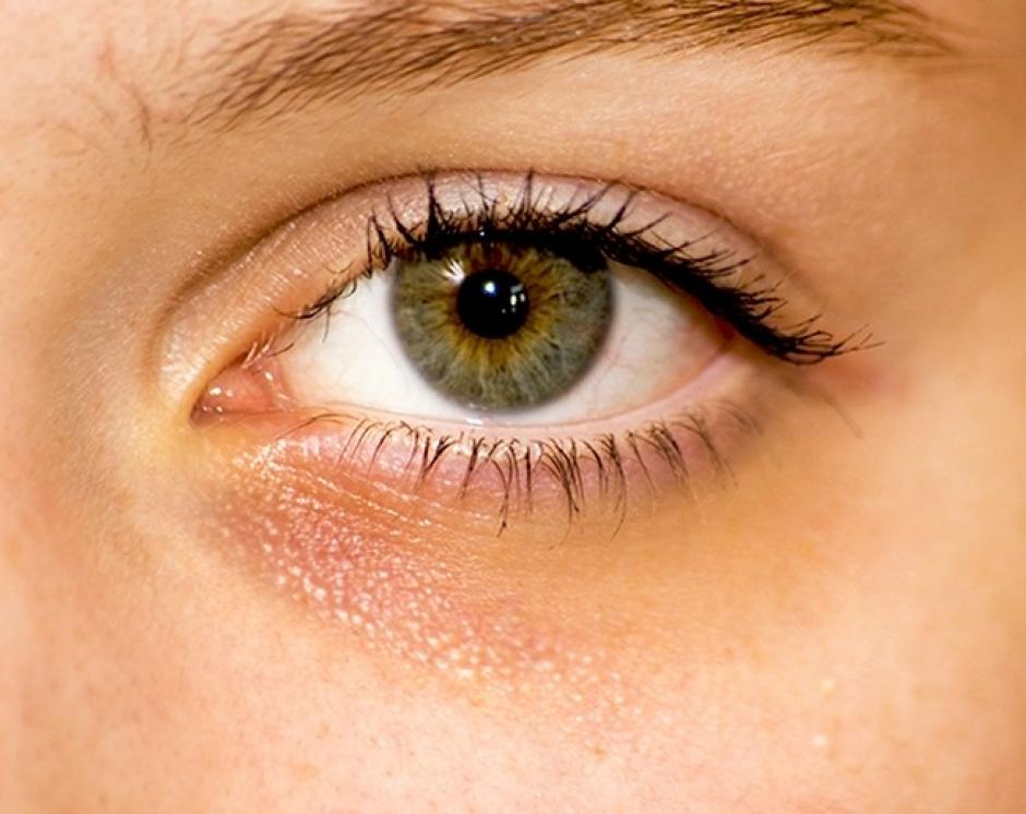 Ojeras. (Foto: Genial Gur&uacute;/Pixabay)