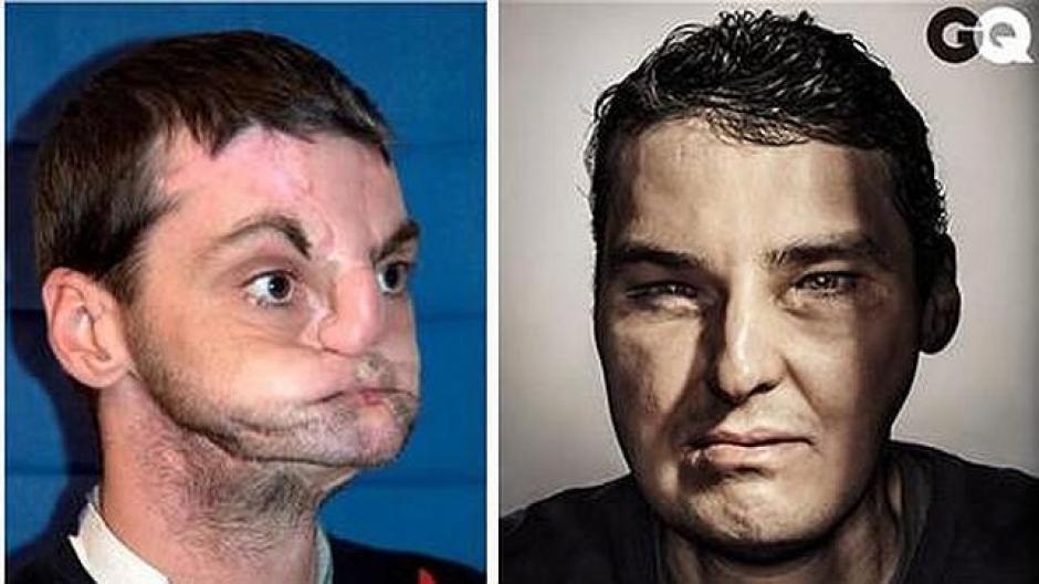 Richard Lee Norris, el primer hombre a quien se le trasplantó un rostro completo.