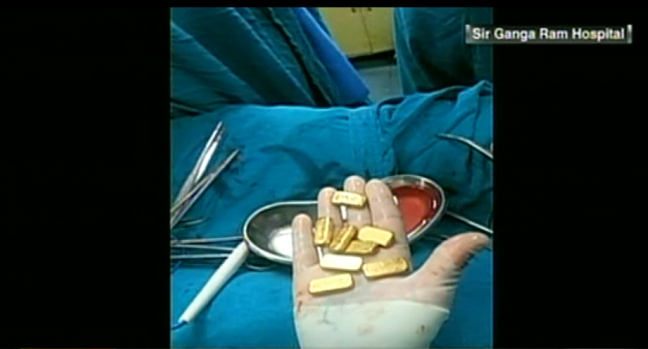 12 peque&ntilde;os lingotes de oro fueron encontrados en el est&oacute;mago de un ciudadano de India. (Foto:CNN)&nbsp;