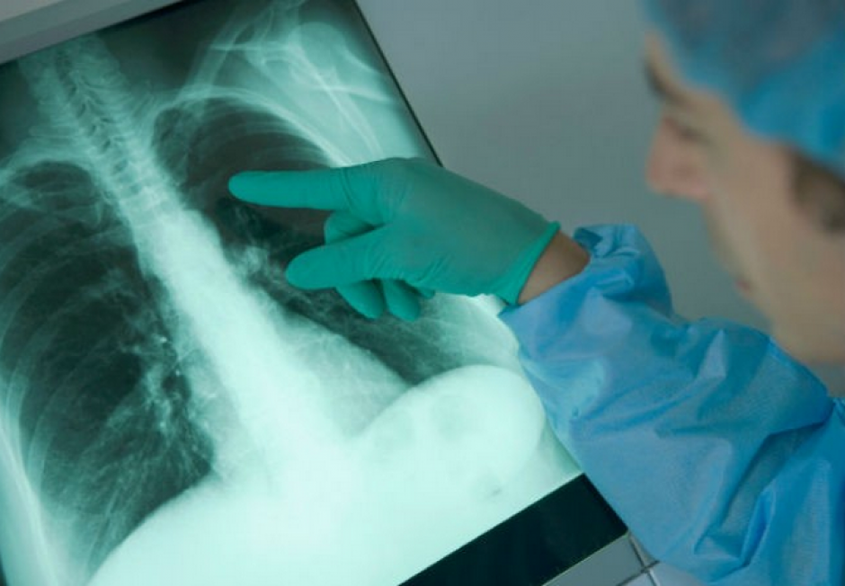 El estudio, publicado en la revista de la Asociaci&oacute;n M&eacute;dica Estadounidense, es el primero que se focaliza s&oacute;lo en pacientes de pulmon&iacute;a sin historia previa de enfermedades cardiovasculares. (Foto: AFP)&nbsp;