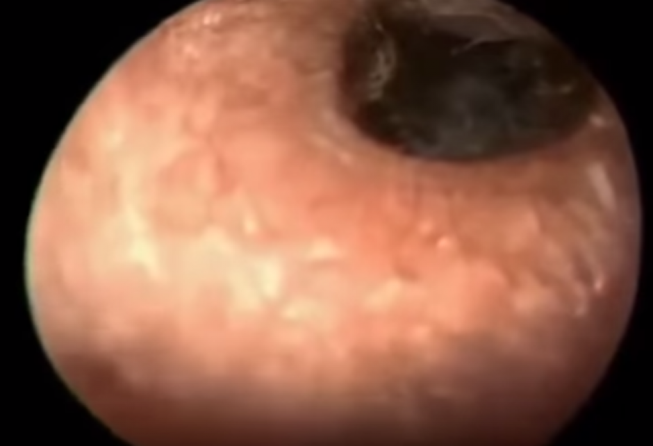 El o&iacute;do fue el lugar escogido por una cucaracha para poner sus huevecillos. (Imagen: YouTube)