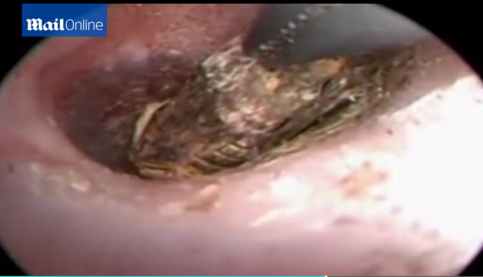 Un ciempi&eacute;s fue removido del o&iacute;do de una mujer en China. (Foto: Daily Mail)