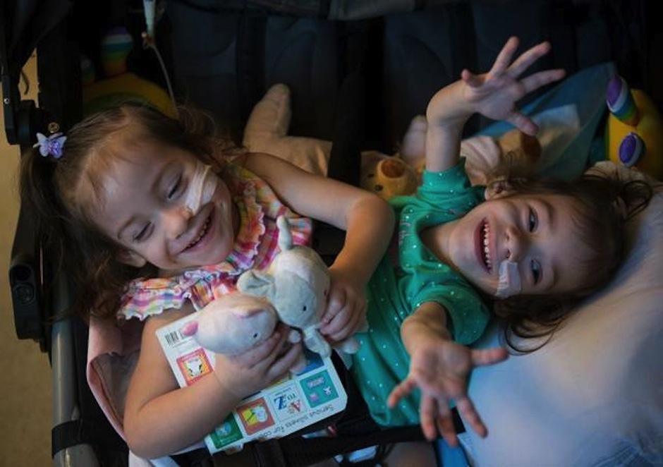 Eva y Erika fueron separadas luego de 2 a&ntilde;os de ser siamesas. (Foto: Sacramento Bee)